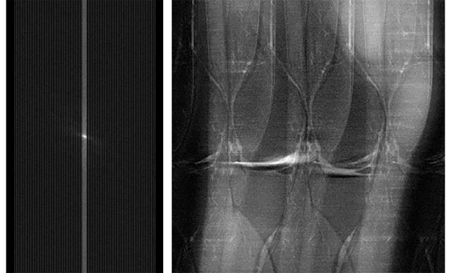 (L) Raw MRI data that has been under-sampled. The MRI scan to capture this data was conducted more quickly than one to capture full data, but the under-sampled data captured creates noise and artifacts in the resulting MRI image. (R) MRI image of the knee reconstructed from subsampled data. The fastMRI project seeks to use AI to create useful MRI images, without noise and artifacts like those shown here.