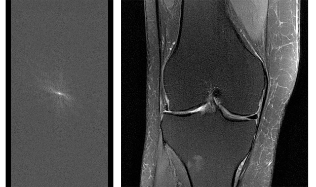 Raw MRI data before it’s converted to an image, shown alongside an MRI image of the knee reconstructed from fully sampled raw data.